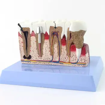 Патологични човешките зъби от PVC с модела на гръбната карта, медицински анатомични модели, училище